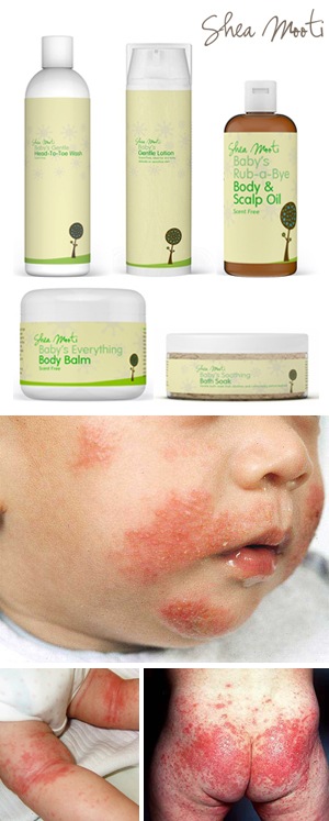 Shea Mooti: Så vårdar du baby och barns känsliga hud vid köldallergi, eksem och torr hud